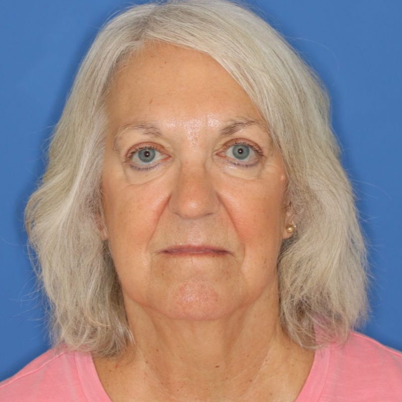 After photos of a 67 year old female who underwent bilateral upper blepharoplasty under local anesthesia in office.