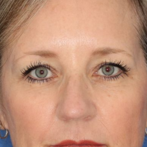 Before photos of a 52 year old female who underwent bilateral upper blepharoplasty under local anesthesia in office.