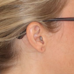 Close up of a person before earlobe repair at Carson Williams Facial Plastic Surgery in Leawood, KS
