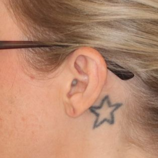 Close up of a person before earlobe repair at Carson Williams Facial Plastic Surgery in Leawood, KS