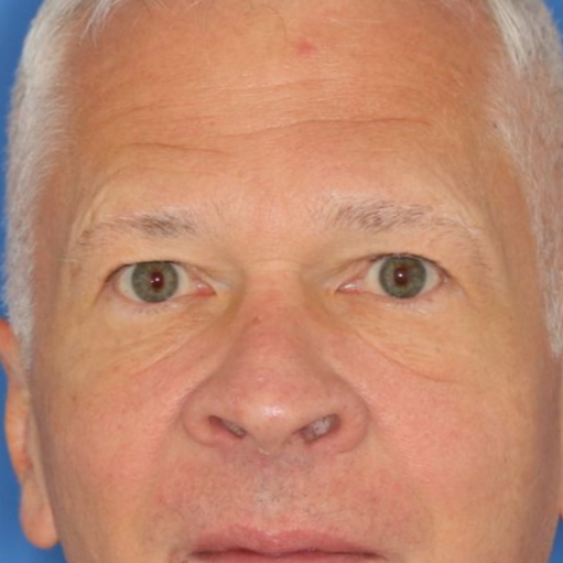 63 year old male who underwent bilateral upper blepharoplasty under local anesthesia in office.