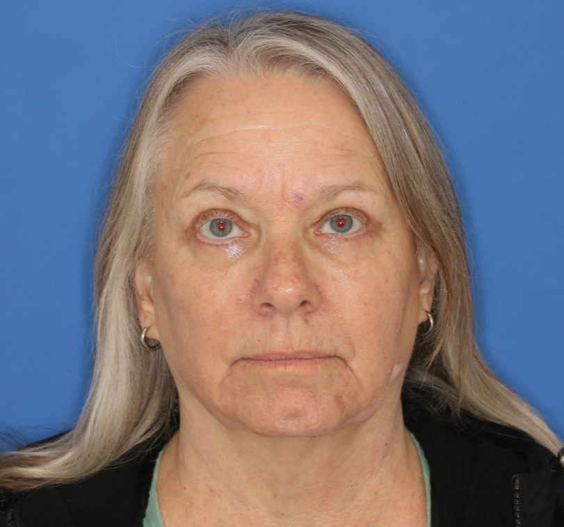 After photo of a 68 year old female who underwent bilateral upper blepharoplasty.