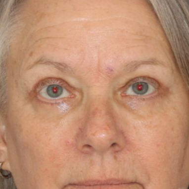 After photo of a 68 year old female who underwent bilateral upper blepharoplasty. 