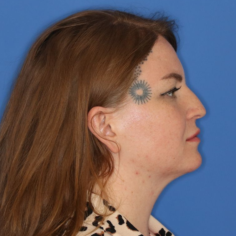 Side profile of a woman before receiving surgery