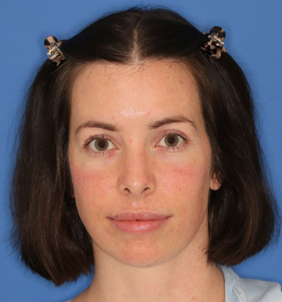Healed results after a blepharoplasty surgery