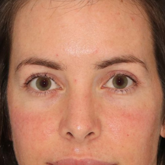 Healed results after a blepharoplasty surgery