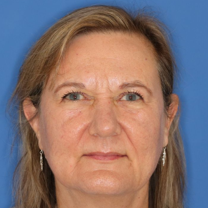 Close up of woman's face after  CO2 laser treatment at Carson Williams MD Facial Plastic Surgery