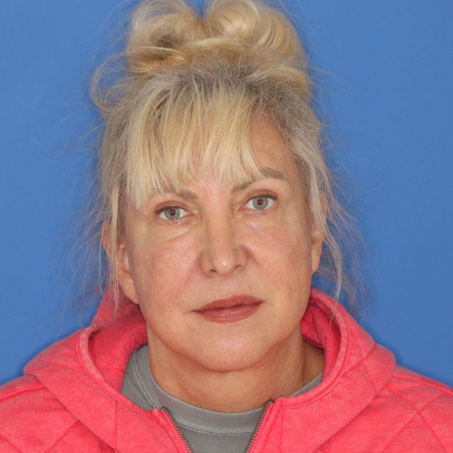 60 year old female posing for a before photo on a blue background