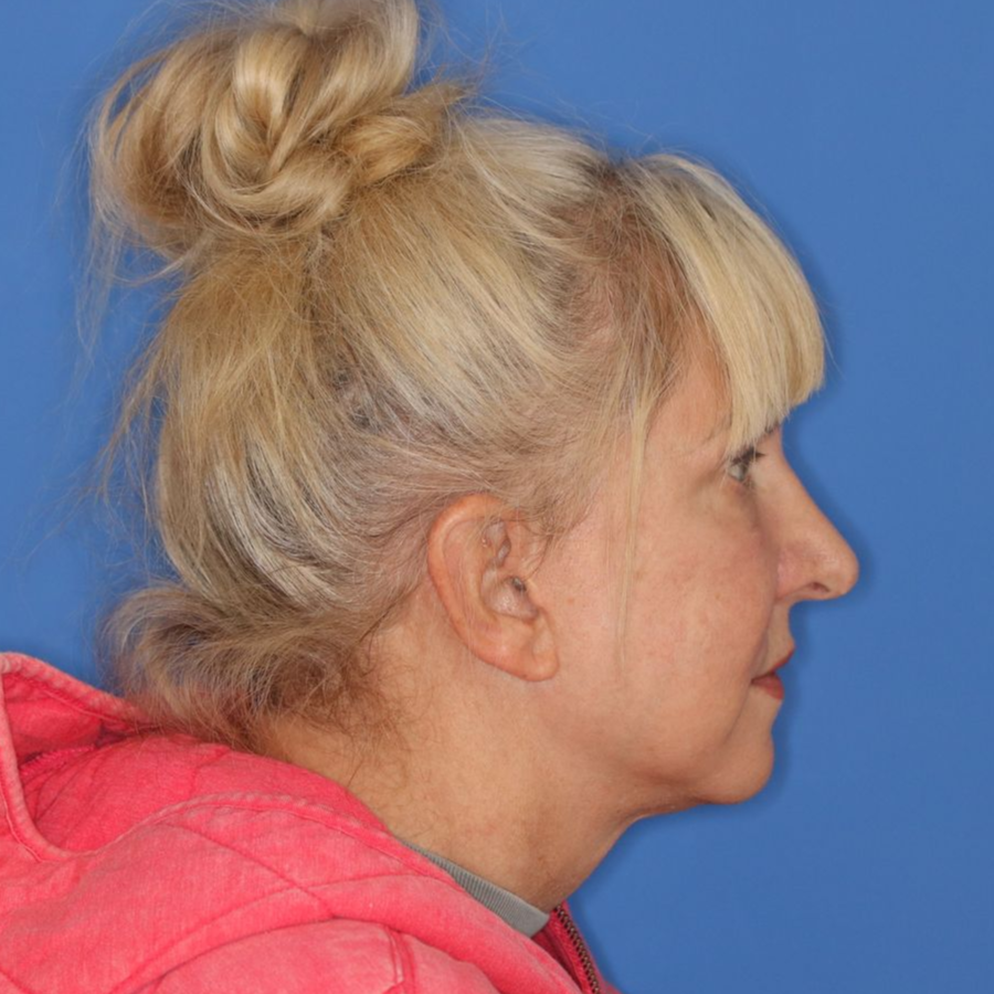 60 year old female facing to the right posing for a before photo