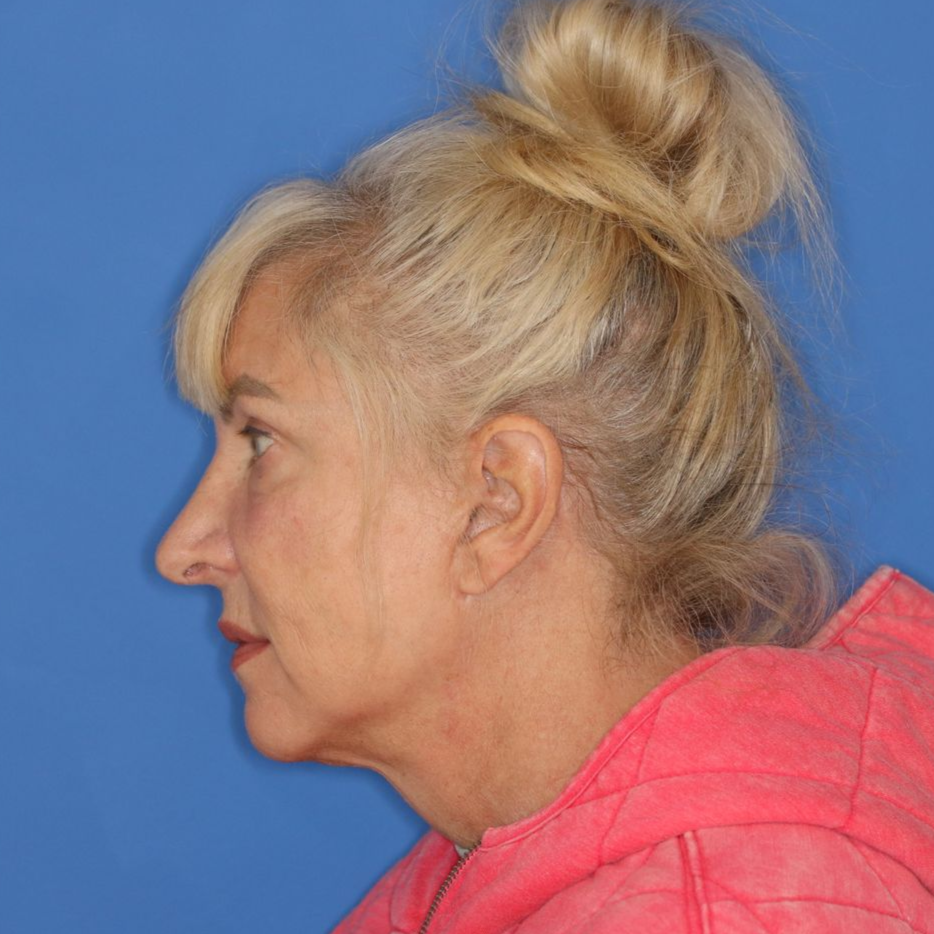 60 year old female facing to the left posing in front of a blue background before receiving surgery
