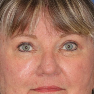 After photos of a 67 year old female who underwent bilateral upper blepharoplasty.
