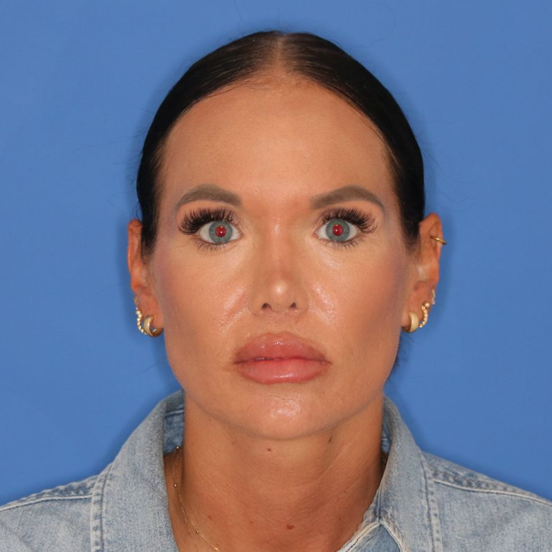 38 year old female after undergoing cosmetic rhinoplasty posing on a blue background