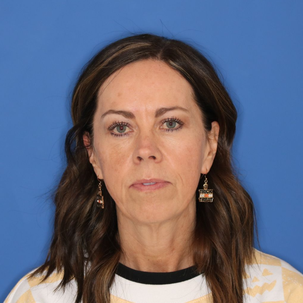 Woman posing in front of a blue background before a facelift