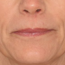 55 year old female before undergoing deep plane face and neck lift posing on a blue background