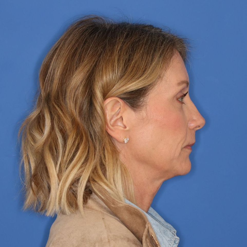 55 year old female posing for before photos on a blue background