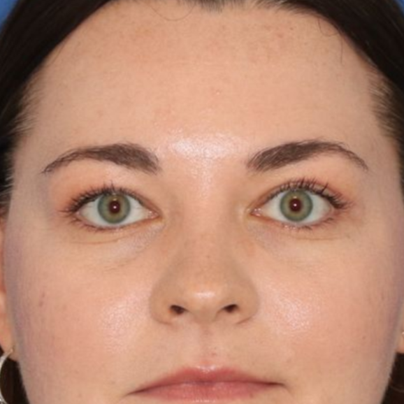 A 35 year old woman after a blepharoplasty surgery