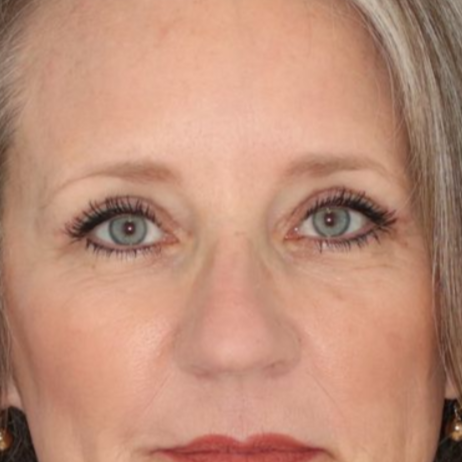 After results of a 52 year old female who underwent bilateral upper blepharoplasty under local anesthesia in office.