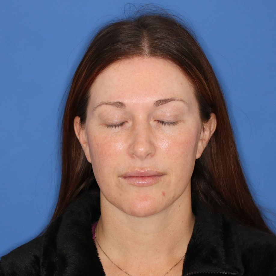 35 year old woman closing her eyes to show before photos of a blepharoplasty