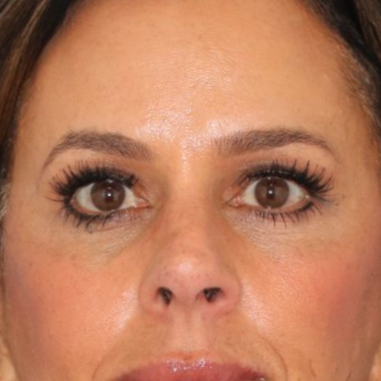 51 year old female underwent deep plane face and neck lift, endoscopic brow lift and lower blepharoplasty