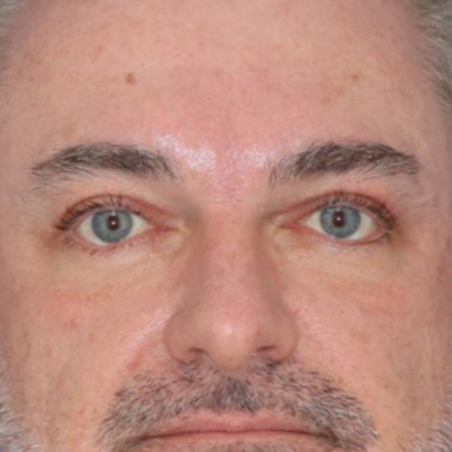 51 year old male posing for an after photo who underwent bilateral upper blepharoplasty under local anesthesia in office.
