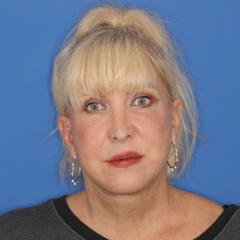 60 year old female posing in front of a blue background after surgery