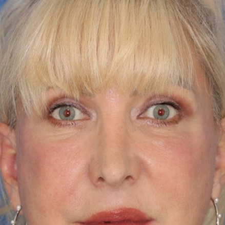 60 year old female posing in front of a blue background after surgery