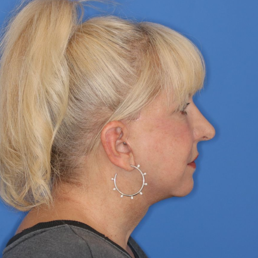60 year old female facing to the right posing for an after surgery photo