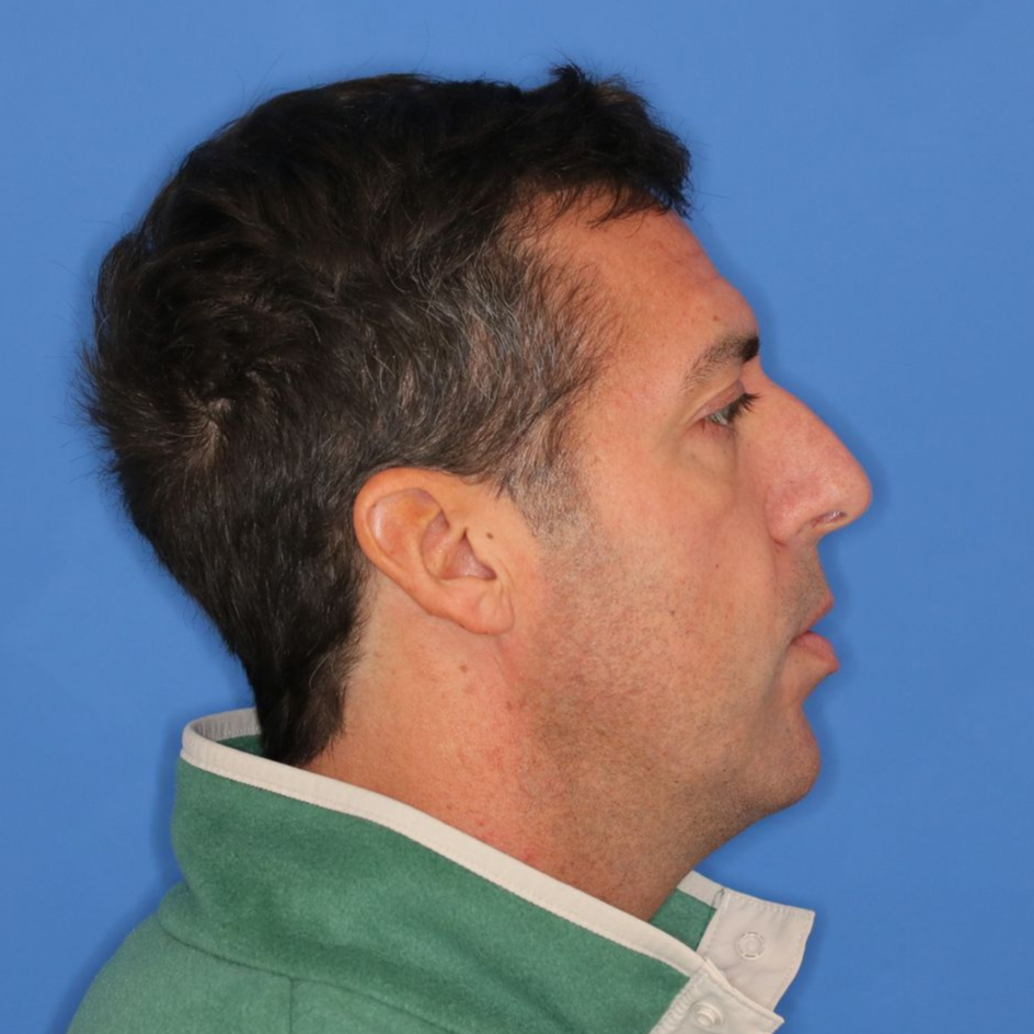42 year old male facing to the right in front of a blue background posing for before photos 