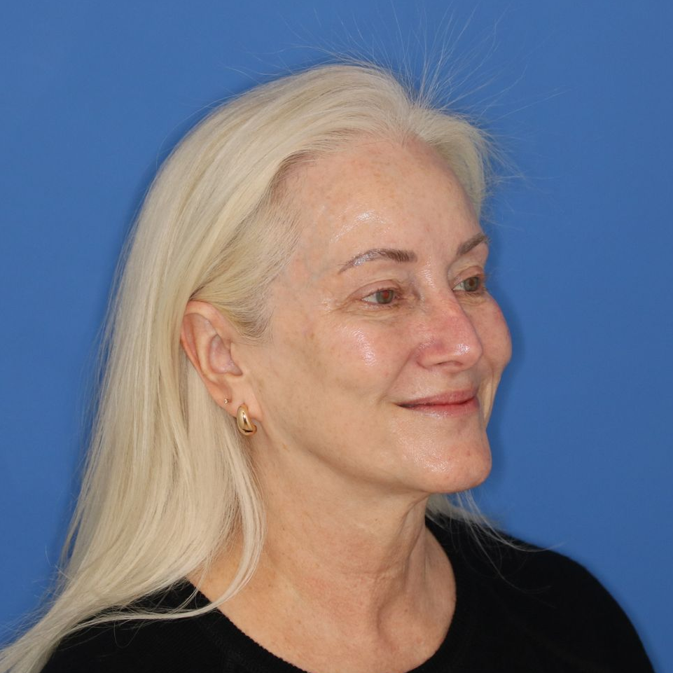 Woman facing to the right posing before receiving a facelift