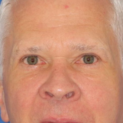 The results of a 63 year old male who underwent bilateral upper blepharoplasty under local anesthesia in office.