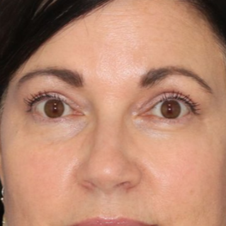 A 51 year old female after photo, who underwent bilateral upper blepharoplasty under local anesthesia in office. 