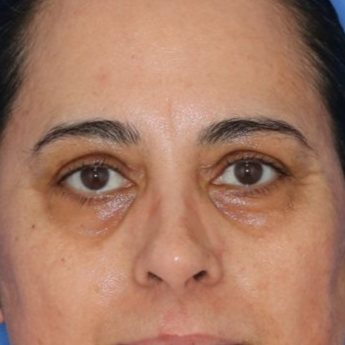 Woman for before photos on a blue background