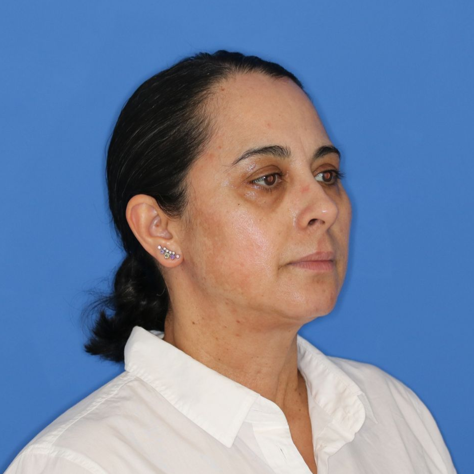 55 year old female underwent deep plane face and neck lift posing for an before photo on a blue background