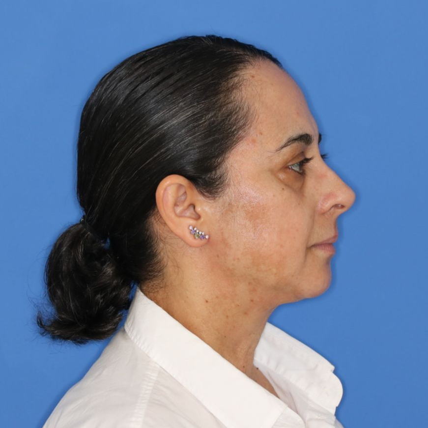 55 year old female before undergoing deep plane face and neck lift posing on a blue background