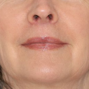 58 year old female underwent upper lip lift in office under local anesthesia.