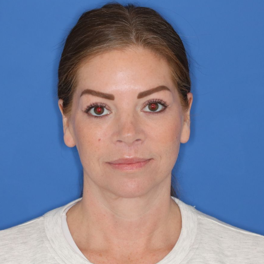 43 year old female posing in front of a blue background after surgery