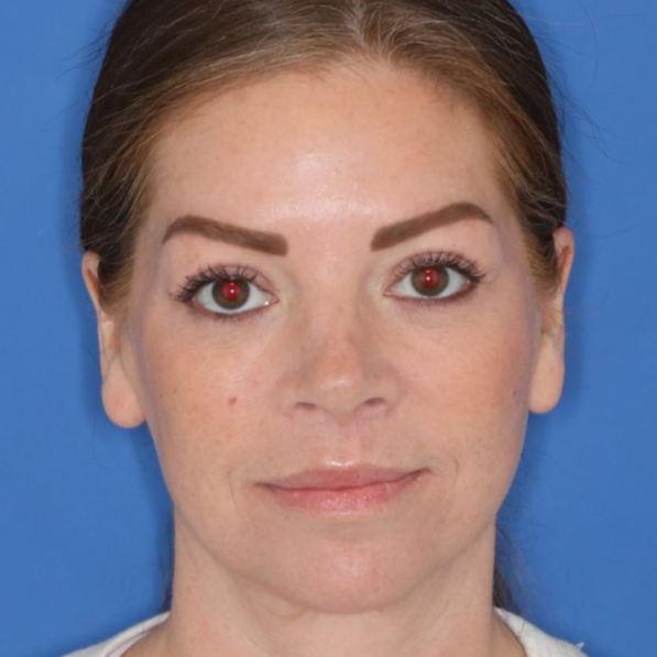 43 year old female underwent a lip lift posing for an after photo