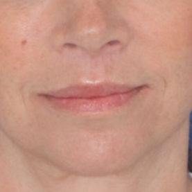 43 year old female in front of a blue background after surgery