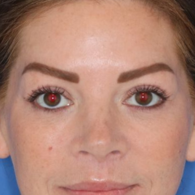 43 year old woman underwent deep plane face and neck lift, upper lip lift, upper and lower blepharoplasty