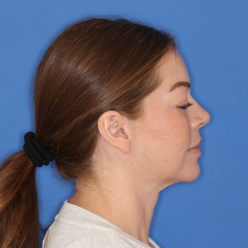 43 year old female facing to the right  in front of a blue background before surgery