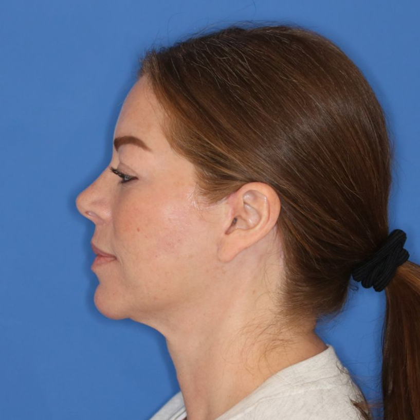 43 year old female facing to the left in front of a blue background after surgery