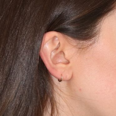 Close up of a person before earlobe repair at Carson Williams Facial Plastic Surgery in Leawood, KS