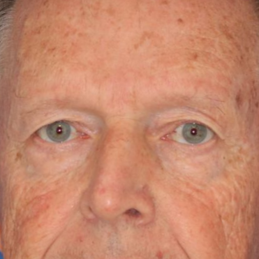 Man posing in front of a blue background before a blepharoplasty