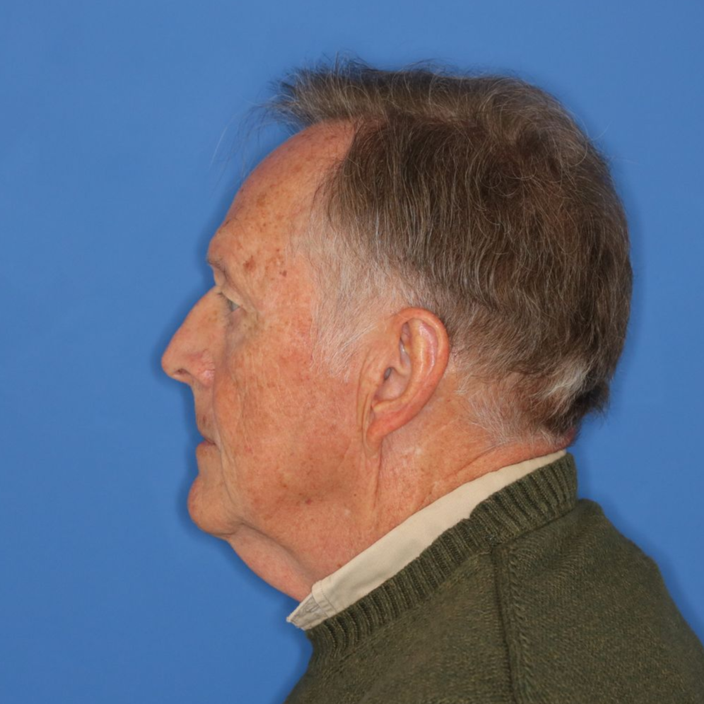 Man facing to the left before undergoing surgery