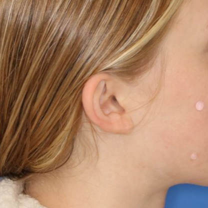 Close up of a person before earlobe repair at Carson Williams Facial Plastic Surgery in Leawood, KS