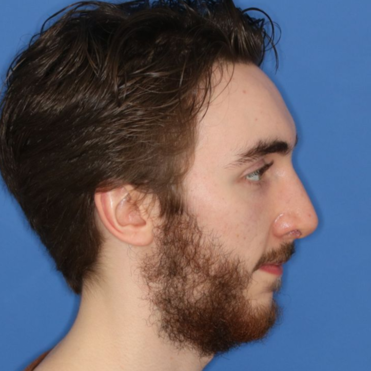 Side profile of a man's face after undergoing a rhinoplasty