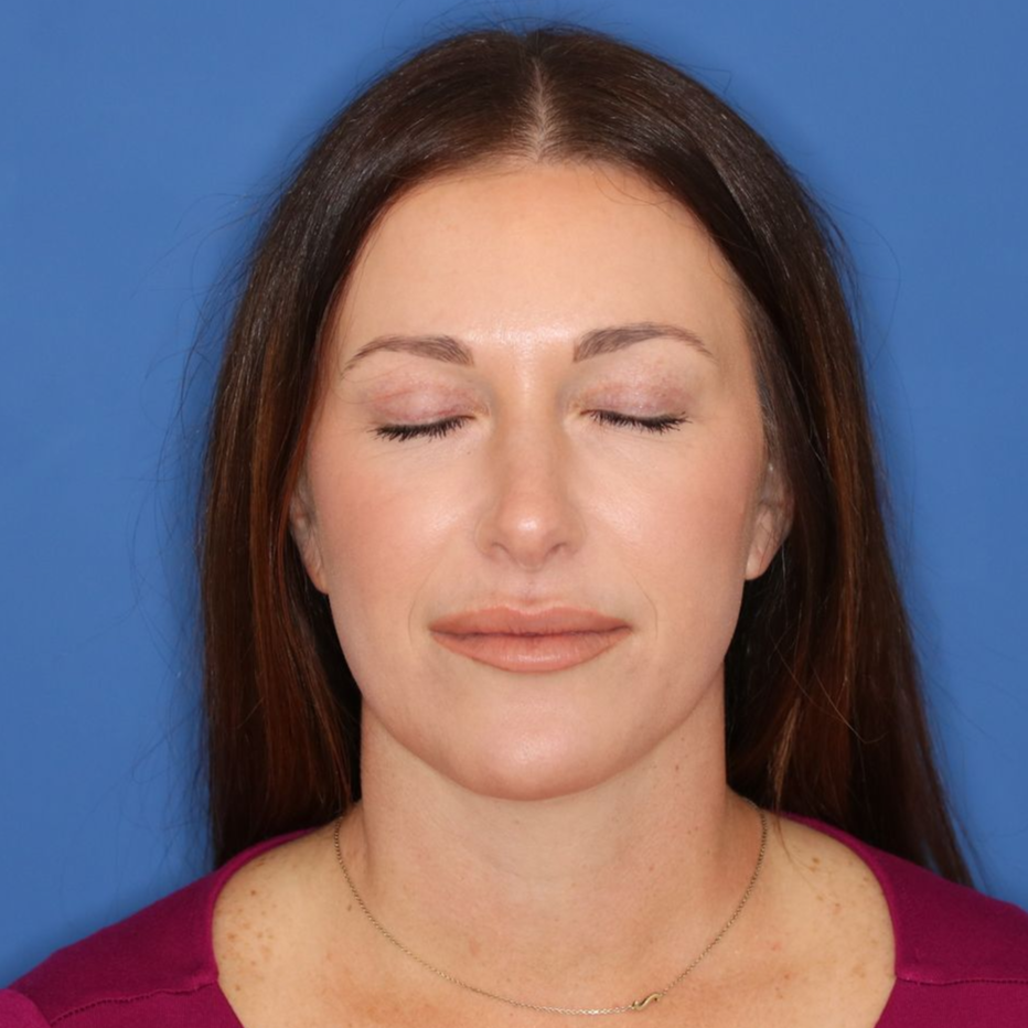 35 year old woman closing her eyes showing the results of a blepharoplasty
