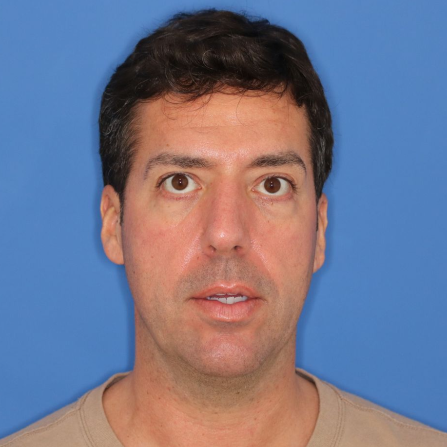 42 year old male standing in front of a blue background posing for after photos after a rhinoplasty