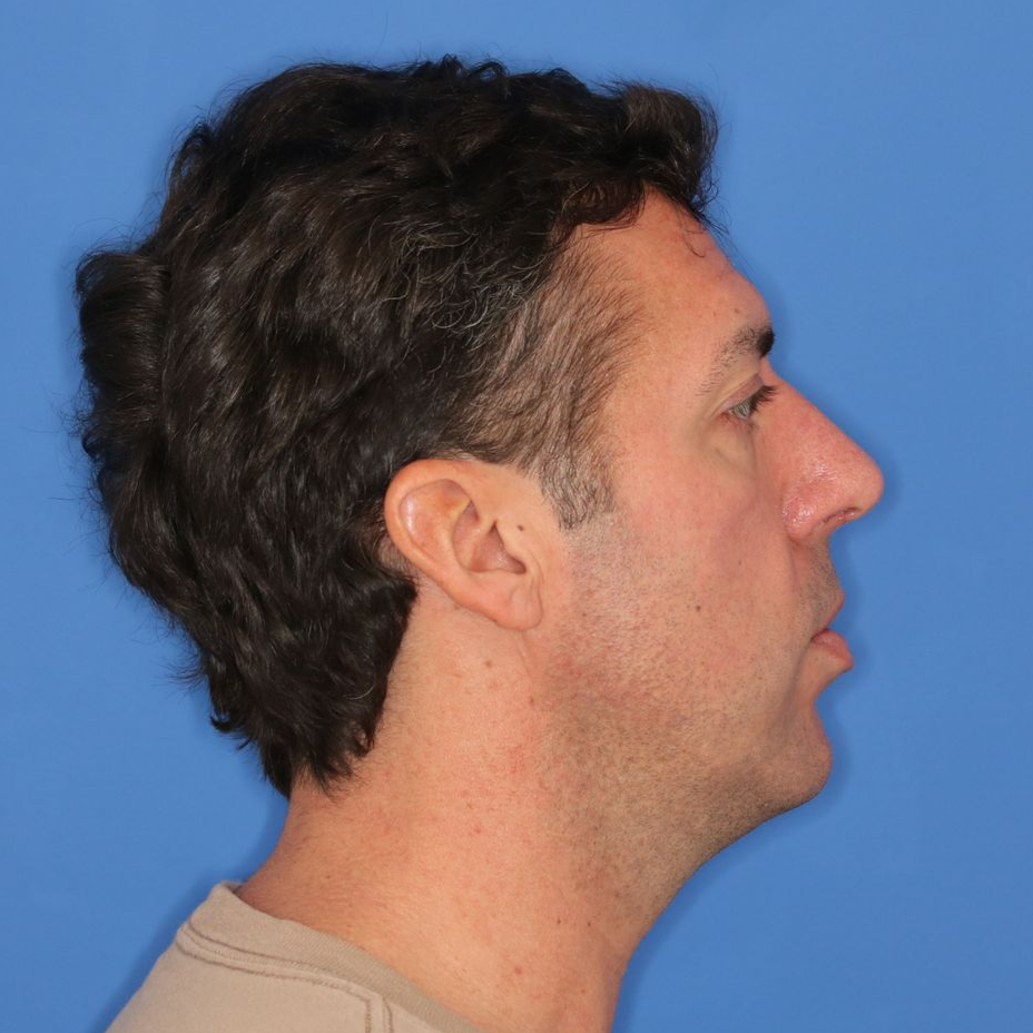 42 year old male facing to the right of a blue background posing for before photos 