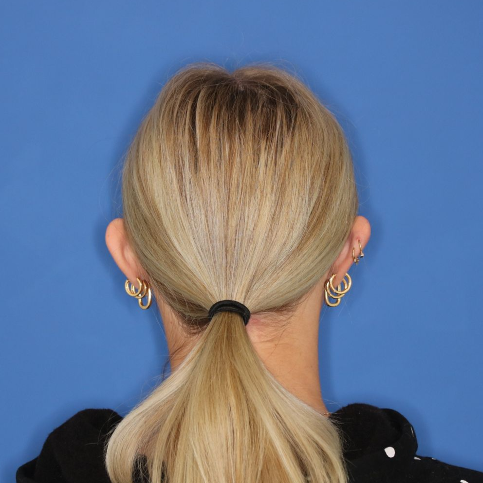 17 year old girl before receiving an otoplasty